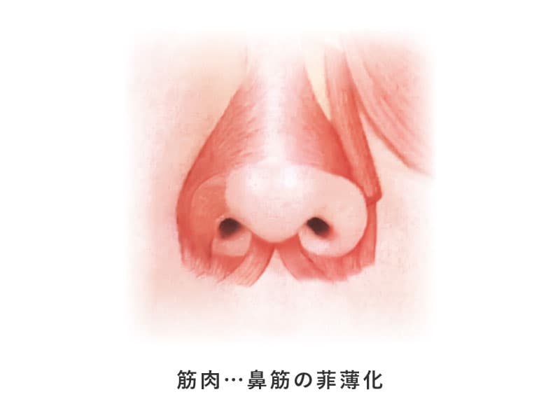 鼻筋の菲薄化を表現した解剖学的なイメージ画像