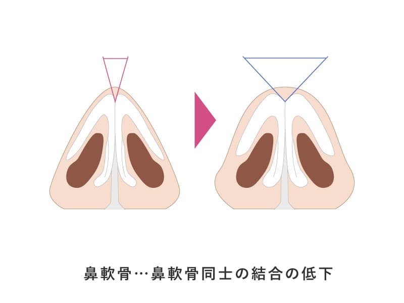 鼻軟骨同士の結合が低下することで、鼻先が広く丸い団子鼻に変化することを示したイメージ画像