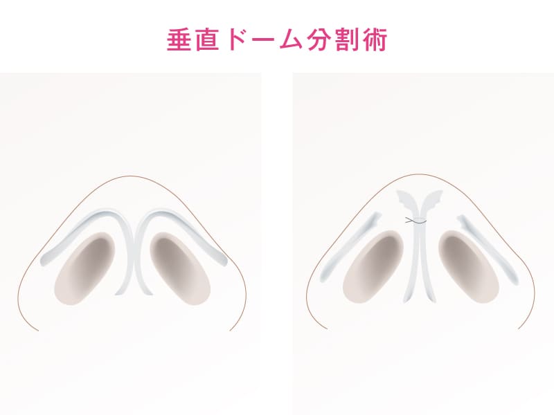 垂直ドーム分割術の解説イラスト