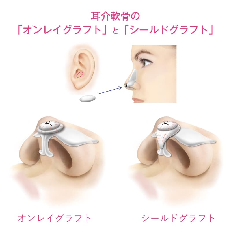 耳介軟骨の「オンレイグラフト」と「シールドグラフト」の解説イラスト