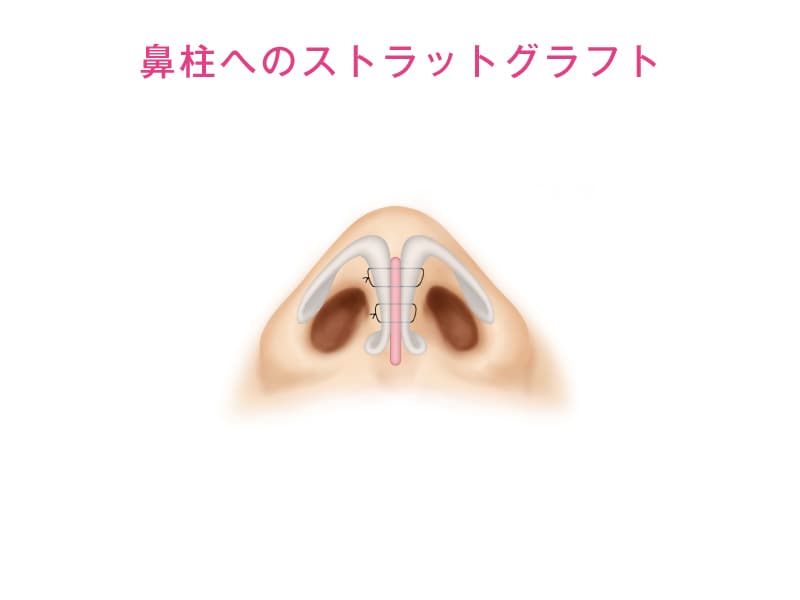 鼻柱へのストラットグラフトの解説イラスト