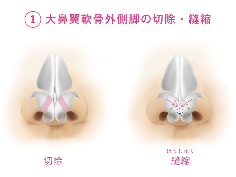 大鼻翼軟骨外側脚の切除・縫縮を開設したイラスト