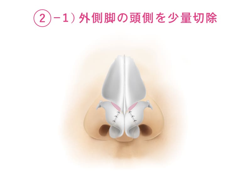 外側脚の頭側を少量切除を解説したイラスト