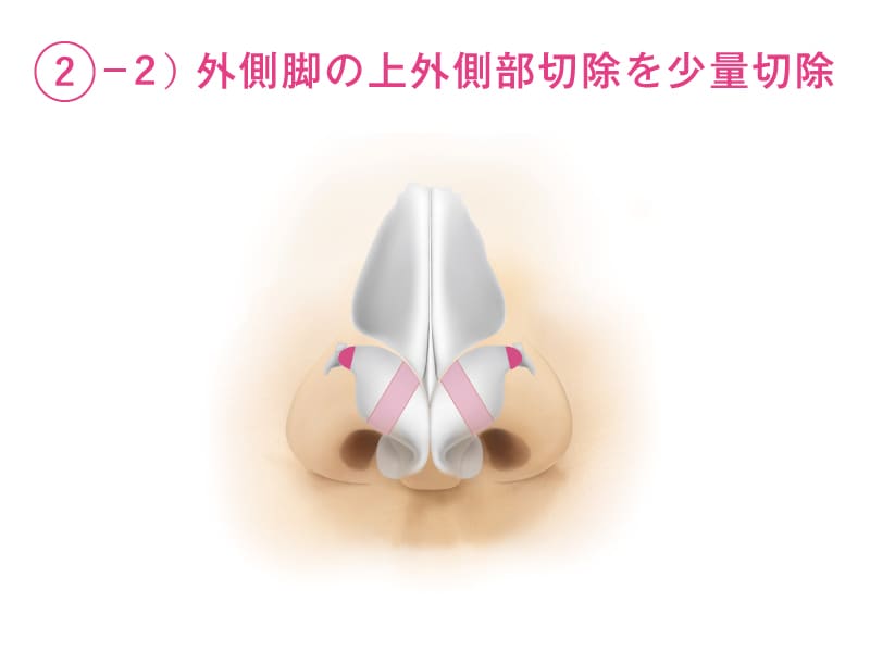 外側脚の上外側部切除を少量切除することを解説したイラスト