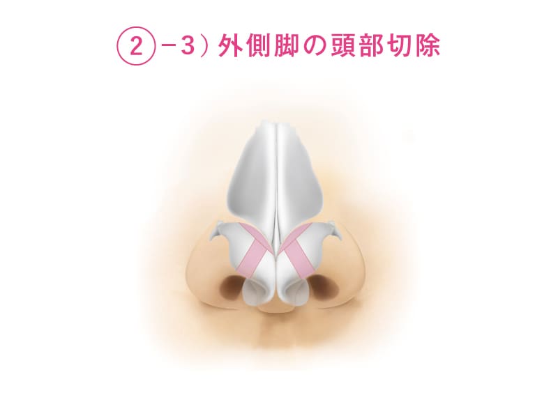 外側脚の頭部切除を開設したイラスト