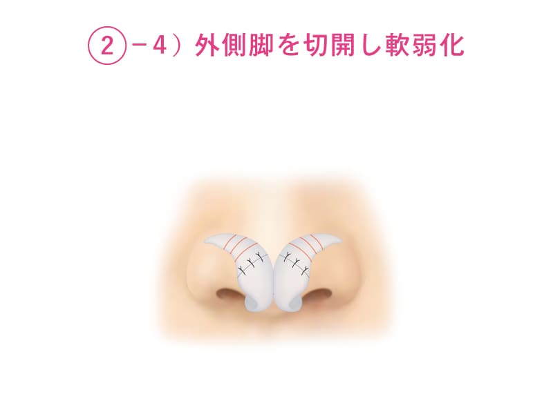 外側脚を切開し軟弱化させることを開設したイラスト