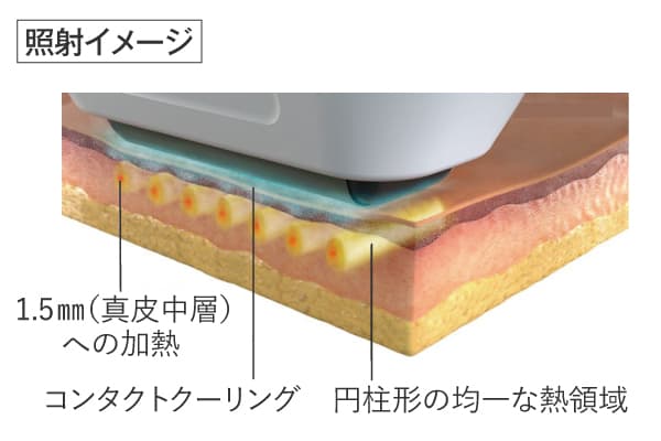 ソフウェーブ照射イメージ