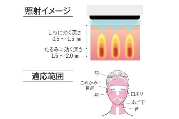 ソフウェーブ照射イメージ＆適応範囲