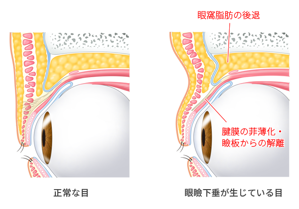 眼瞼下垂の解剖的図解イラスト