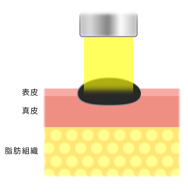 炭酸ガスレーザー法の図解イラスト。レーザーでの照射