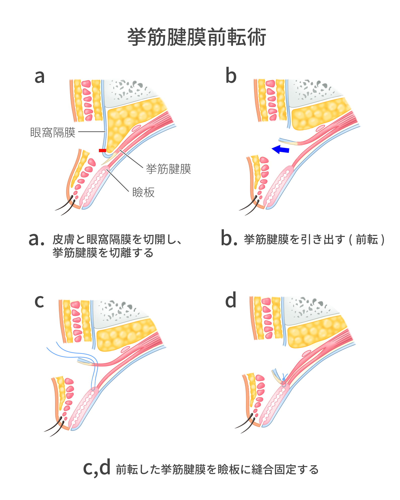 挙筋腱膜前転術の解剖学的な図解イラスト