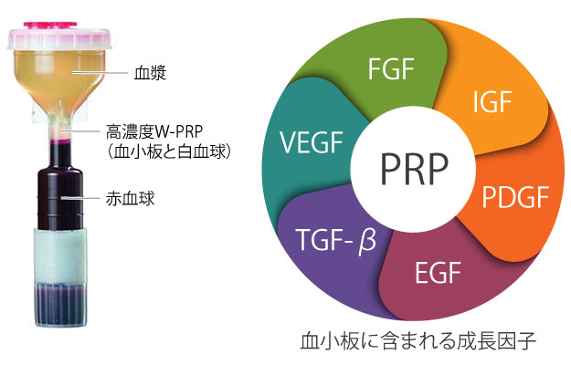 高濃度W-PRP療法