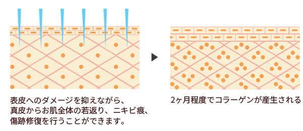 ダーマペン効果の仕組み