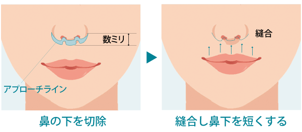 リップリフトの手術方法