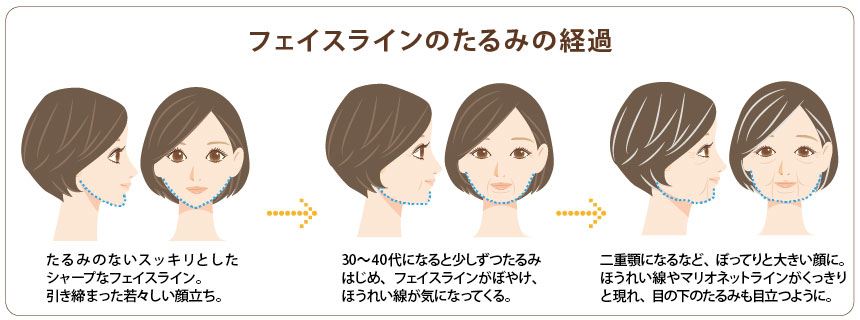 フェイスラインのたるみの経過