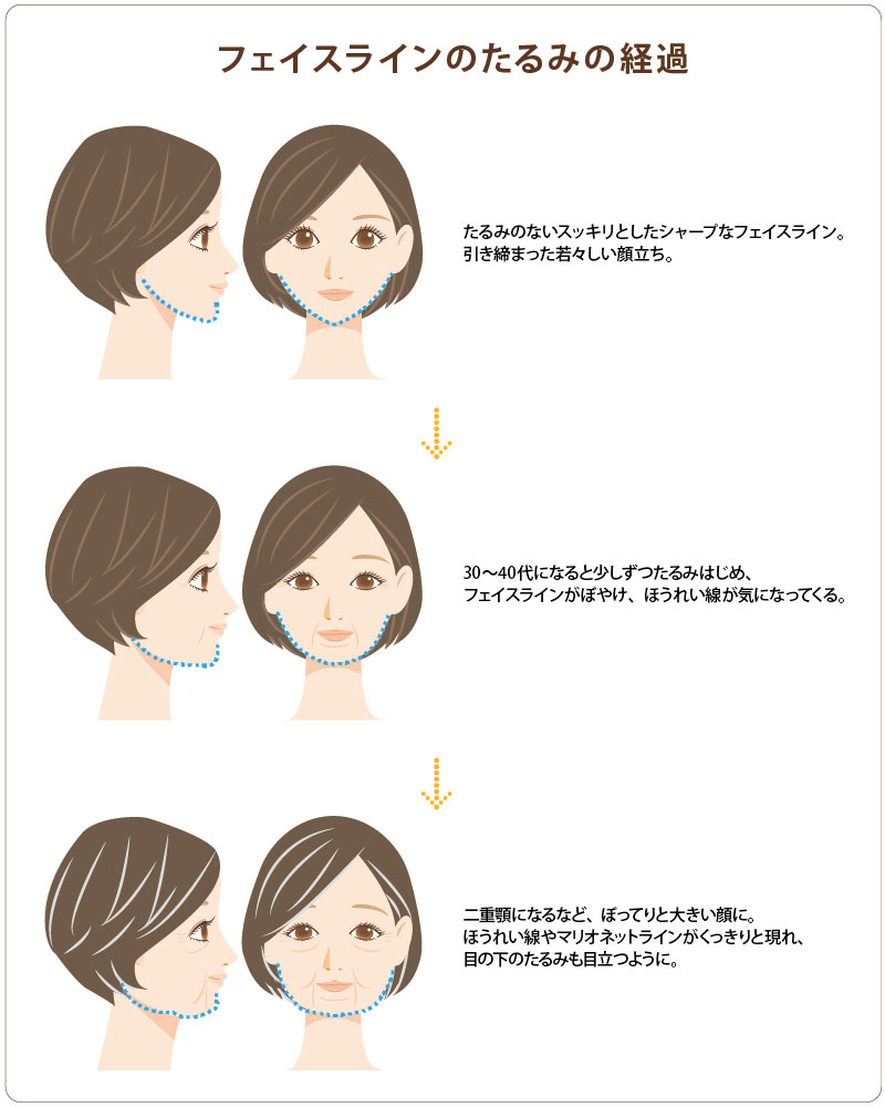 フェイスラインのたるみの経過