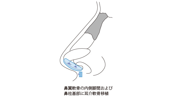 鼻柱形成術の症例写真
