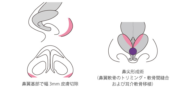 小鼻縮小術+鼻尖縮小術の症例写真