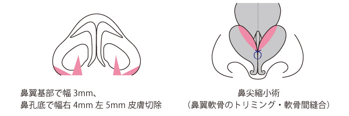 小鼻縮小術+鼻孔底（鼻翼幅）縮小術+鼻尖縮小術の症例写真