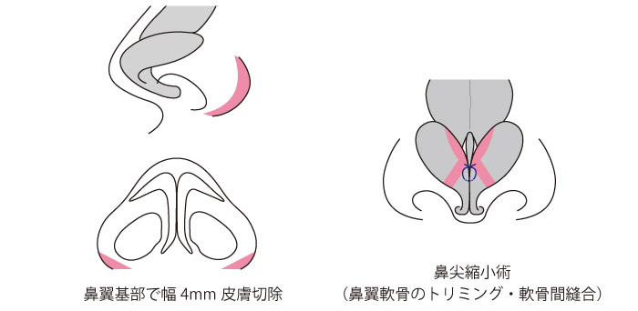 小鼻縮小術+鼻尖縮小術の症例写真