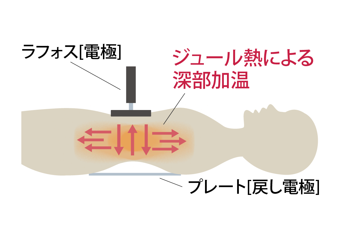 ラフォスイメージ図