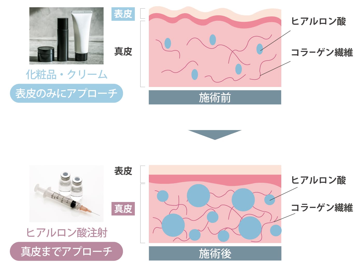 ボライトXCメカニズム図