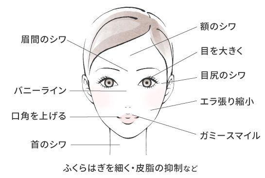 ボトックス適応部位