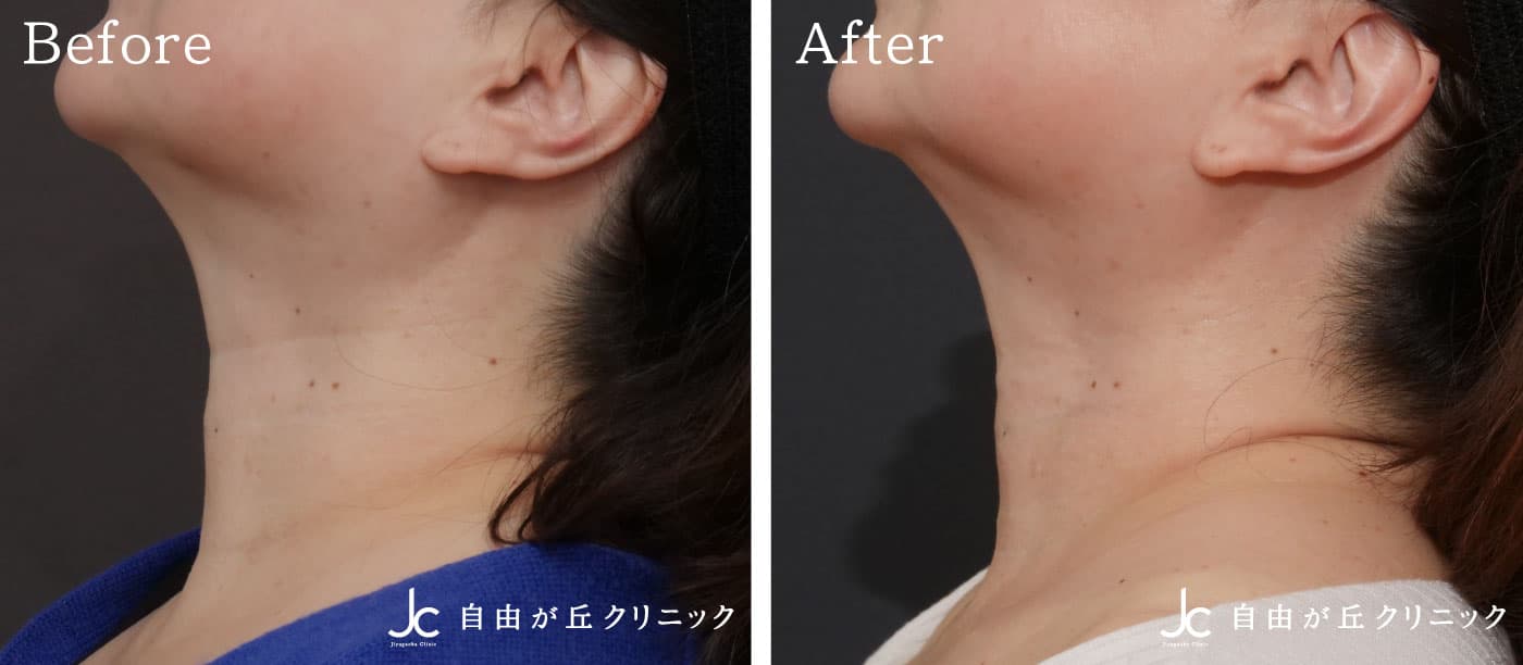 トータルネックケア症例写真